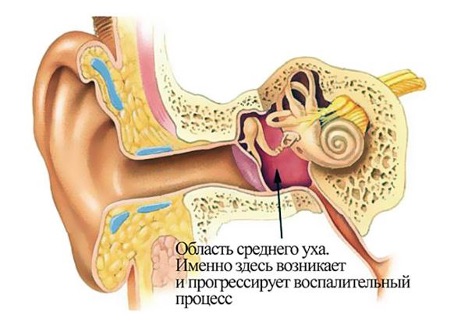 Хронический средний отит: не всё, что течёт — ХСО!
