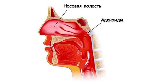 Аденоидная вегетация у взрослых: миф или реальность?