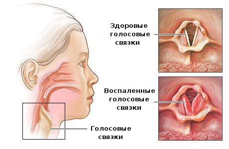 Хронический ларингит у учителей: профзаболевание, о котором молчат